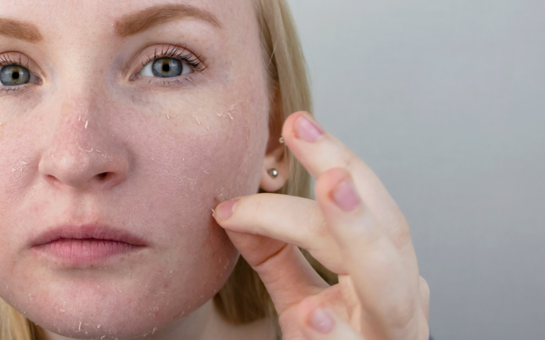 Peau sèche : décryptage et solutions pour un hiver en beauté.