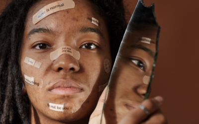 Acné : 4 étapes essentielles pour retrouver une belle peau.