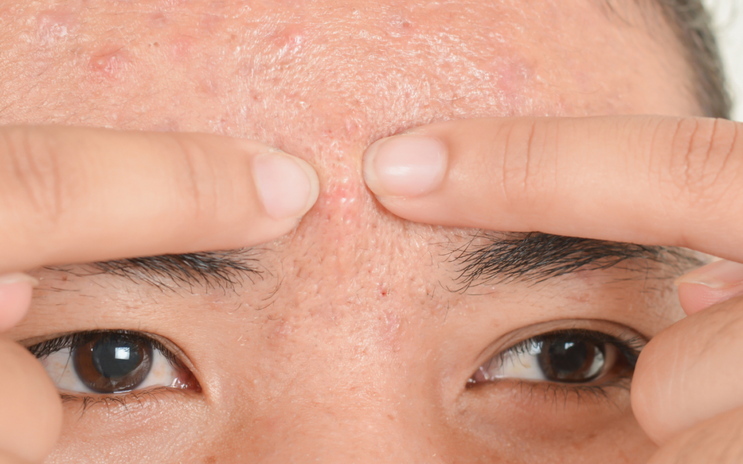 Peau acnéique : stop aux préjugés !