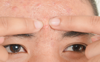 Peau acnéique : stop aux préjugés !