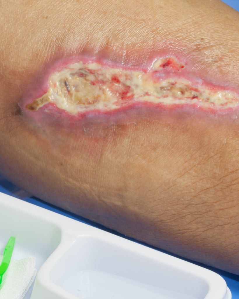 Le cortisol empêche la cicatrisation