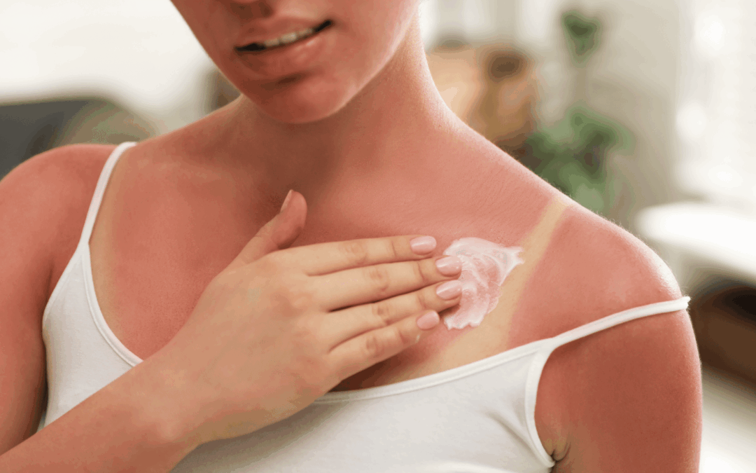 Soigner un coup de soleil efficacement : alerte épiderme brûlé !