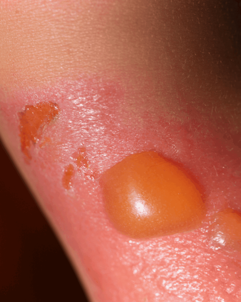 La brûlure du second degré.