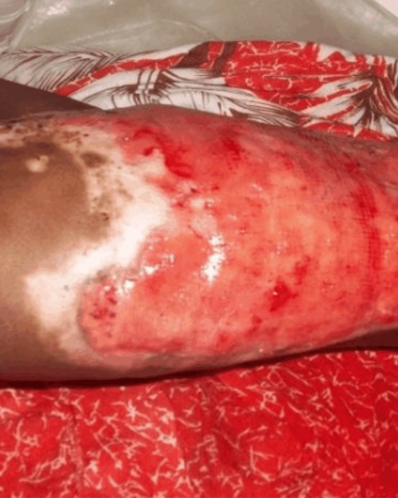 Brûlure au 3ᵉ degré : l'urgence vitale