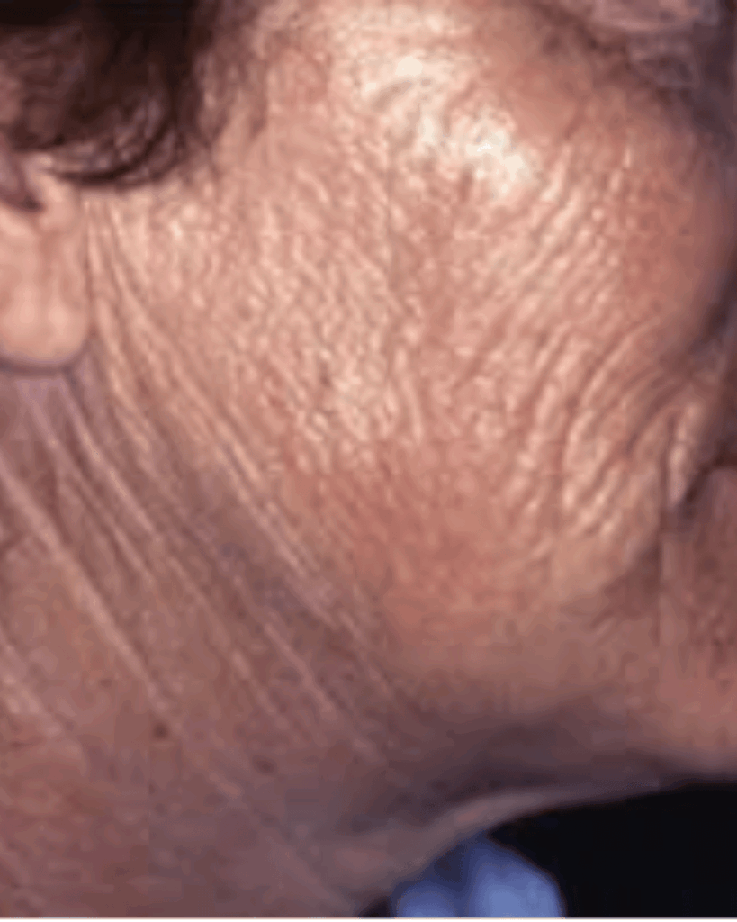 Soigner vos coups de soleil pour éviter le photovieillissement cutané.