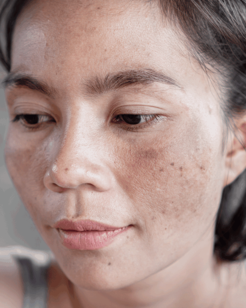 L'hyper-pigmentation, un risque du retour de vacances.