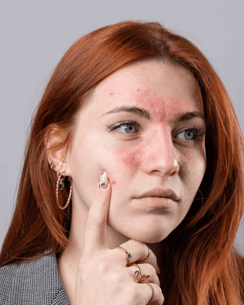 Irritations dues à l'association Rétinol et peroxyde de benzoyl.