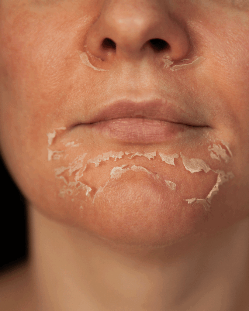 Les rétinoides et les Acides exfoliants, une association à bannir pour les soins de la peau.